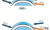 疫情过后，孩子视力不OK，OK镜来帮您