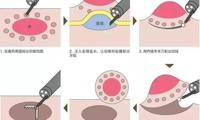 【中医院故事】“不开刀”的胃肠早癌治疗——ESD你知道吗？