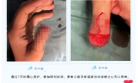 【中医院故事】 移花接木：脚趾“变”手指
