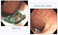 【中医院故事】发现一例早癌，挽救一条生命，拯救一个家庭