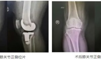 【中医院故事】70岁双胞胎姐妹，双双换掉了膝盖
