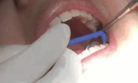 【爱牙日】护牙健齿少年强，我院推出爱牙涂氟活动