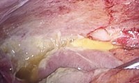 【中医院故事】男子涉水行车致肠穿孔，经紧急手术脱险